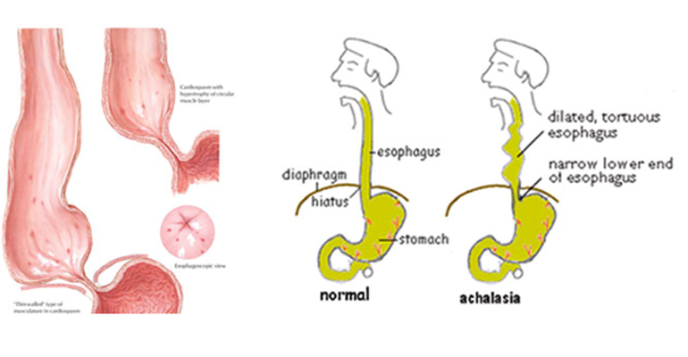 best Achalasia Cardia Doctor in Faridabad