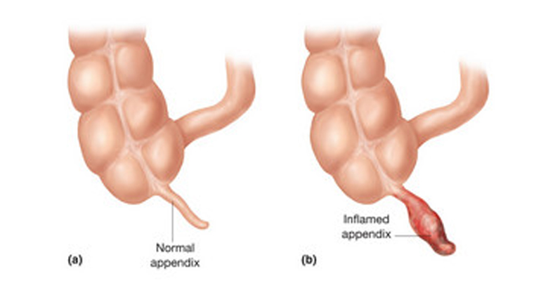 best Laparoscopic appendectomy Doctor in Faridabad