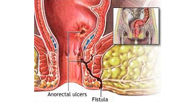 doctor for Anal Fistula Treatment in Faridabad