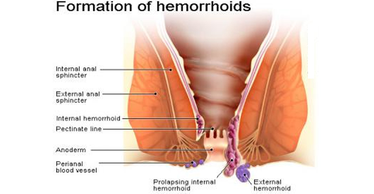 best Piles Treatment Doctor in Faridabad