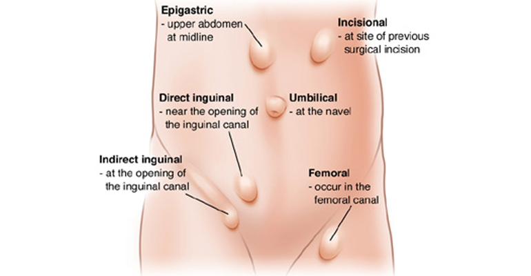 best laparoscopic hernia surgeon in Faridabad