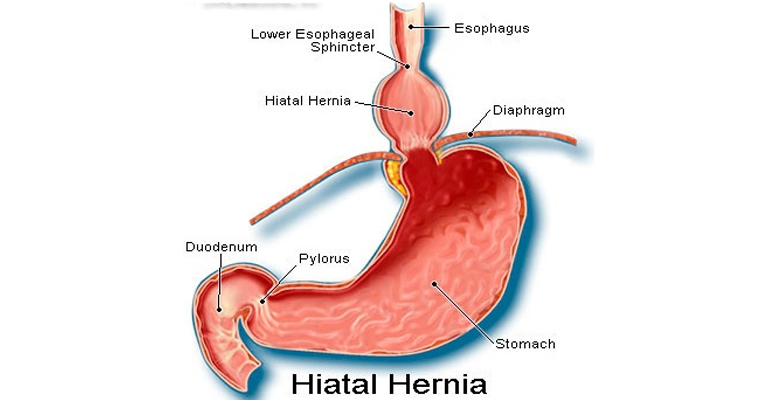 best surgeon for hiatus hernia in Faridabad