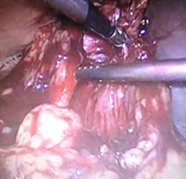 best Piles Treatment Doctor in Faridabad