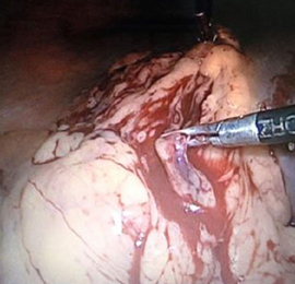 best Gallbladder Surgeon in Faridabad