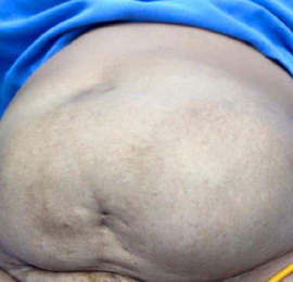 best Laparoscopic Surgeon in Faridabad